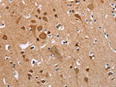 The image on the left is immunohistochemistry of paraffin-embedded Human brain tissue using the antibody Antibody) at dilution 1/35, on the right is treated with fusion protein. (Original magnification: ×200)