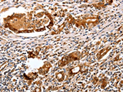 The image on the left is immunohistochemistry of paraffin-embedded Human gastric cancer tissue using PGC Antibody(PGC Antibody) at dilution 1/25, on the right is treated with fusion protein. (Original magnification: ×200)Rabbit anti-Human PGC Polyclonal Antibody