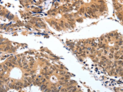 The image on the left is immunohistochemistry of paraffin-embedded Human colon cancer tissue using the antibody Antibody) at dilution 1/25, on the right is treated with fusion protein. (Original magnification: ×200)Rabbit anti-Human PGC Polyclonal Antibody