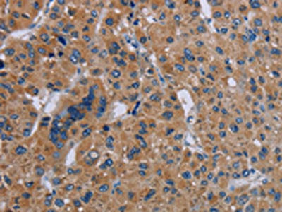 The image on the left is immunohistochemistry of paraffin-embedded Human liver cancer tissue using the antibody Antibody) at dilution 1/40, on the right is treated with fusion protein. (Original magnification: ×200)Rabbit anti-Human IL27RA Polyclonal Antibody