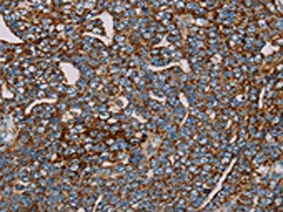 The image on the left is immunohistochemistry of paraffin-embedded Human cervical cancer tissue using MRPL12 Antibody(MRPL12 Antibody) at dilution 1/25, on the right is treated with fusion protein. (Original magnification: ×200)