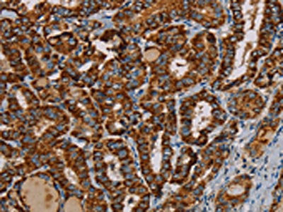 The image on the left is immunohistochemistry of paraffin-embedded Human thyroid cancer tissue using the antibody Antibody) at dilution 1/25, on the right is treated with fusion protein. (Original magnification: ×200)