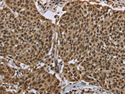 The image on the left is immunohistochemistry of paraffin-embedded Human cervical cancer tissue using the antibody Antibody) at dilution 1/50, on the right is treated with fusion protein. (Original magnification: ×200)Rabbit anti-Human PPAT Polyclonal Antibody