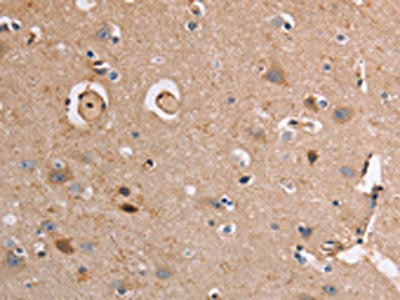 The image on the left is immunohistochemistry of paraffin-embedded Human brain tissue using AKR1B10 Antibody(AKR1B10 Antibody) at dilution 1/20, on the right is treated with fusion protein. (Original magnification: ×200)Rabbit anti-Human AKR1B10 Polyclonal Antibody