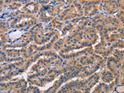 The image on the left is immunohistochemistry of paraffin-embedded Human thyroid cancer tissue using the antibody Antibody) at dilution 1/20, on the right is treated with fusion protein. (Original magnification: ×200)Rabbit anti-Human AKR1B10 Polyclonal Antibody