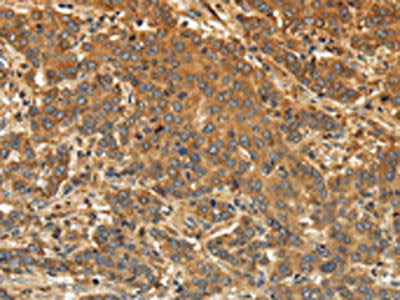 The image on the left is immunohistochemistry of paraffin-embedded Human liver cancer tissue using the antibody Antibody) at dilution 1/30, on the right is treated with synthetic peptide. (Original magnification: ×200)Rabbit anti-Human EDNRA Polyclonal Antibody