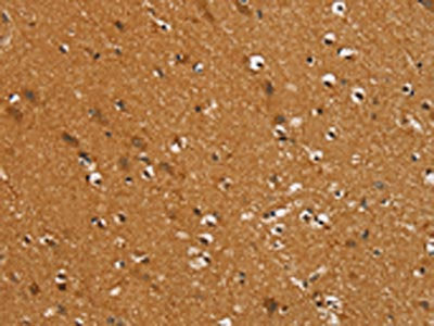 The image on the left is immunohistochemistry of paraffin-embedded Human brain  tissue using SLC16A3 Antibody(SLC16A3 Antibody) at dilution 1/30, on the right is treated with synthetic peptide. (Original magnification: ×200)Rabbit anti-Human SLC16A3 Polyclonal Antibody
