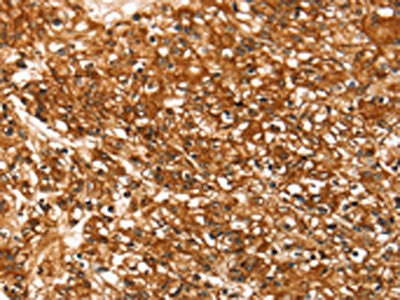The image on the left is immunohistochemistry of paraffin-embedded Human prostate cancer tissue using the antibody Antibody) at dilution 1/30, on the right is treated with synthetic peptide. (Original magnification: ×200)Rabbit anti-Human SLC16A3 Polyclonal Antibody