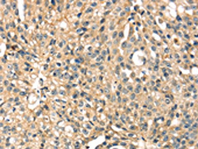 The image on the left is immunohistochemistry of paraffin-embedded Human breast cancer tissue using STX8 Antibody(STX8 Antibody) at dilution 1/35, on the right is treated with fusion protein. (Original magnification: ×200)Rabbit anti-Human STX8 Polyclonal Antibody