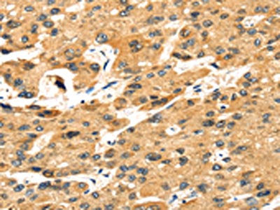 The image on the left is immunohistochemistry of paraffin-embedded Human liver cancer tissue using the antibody Antibody) at dilution 1/35, on the right is treated with fusion protein. (Original magnification: ×200)Rabbit anti-Human STX8 Polyclonal Antibody