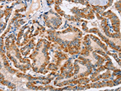 The image on the left is immunohistochemistry of paraffin-embedded Human thyroid cancer tissue using the antibody Antibody) at dilution 1/30, on the right is treated with fusion protein. (Original magnification: ×200)Rabbit anti-Human MSMB Polyclonal Antibody