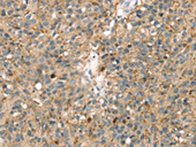 The image on the left is immunohistochemistry of paraffin-embedded Human breast cancer tissue using MAPK12 Antibody(MAPK12 Antibody) at dilution 1/25, on the right is treated with fusion protein. (Original magnification: ×200)Rabbit anti-Human MAPK12 Polyclonal Antibody