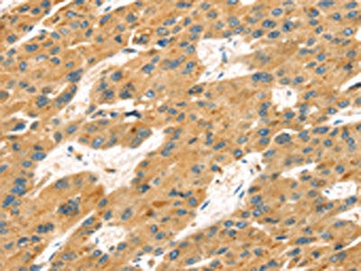 The image on the left is immunohistochemistry of paraffin-embedded Human liver cancer tissue using the antibody Antibody) at dilution 1/25, on the right is treated with fusion protein. (Original magnification: ×200)