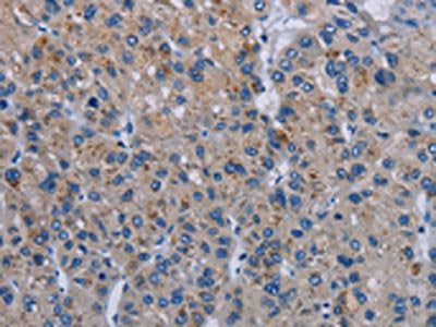 The image on the left is immunohistochemistry of paraffin-embedded Human liver cancer tissue using PDE4D Antibody(PDE4D Antibody) at dilution 1/20, on the right is treated with synthetic peptide. (Original magnification: ×200)Rabbit anti-Human PDE4D Polyclonal Antibody