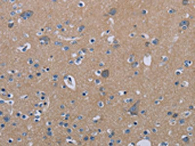 The image on the left is immunohistochemistry of paraffin-embedded Human brain tissue using the antibody Antibody) at dilution 1/20, on the right is treated with synthetic peptide. (Original magnification: ×200)Rabbit anti-Human PDE4D Polyclonal Antibody