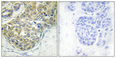 Immunohistochemical analysis of paraffin-embedded human breast carcinoma tissue using ACK1 (Phospho-Tyr284) antibody (left)or the same antibody preincubated with blocking peptide (right).Rabbit anti-Human TNK2 Polyclonal Antibody