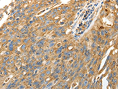 The image on the left is immunohistochemistry of paraffin-embedded Human ovarian cancer tissue using CALR Antibody(CALR Antibody) at dilution 1/50, on the right is treated with fusion protein. (Original magnification: ×200)