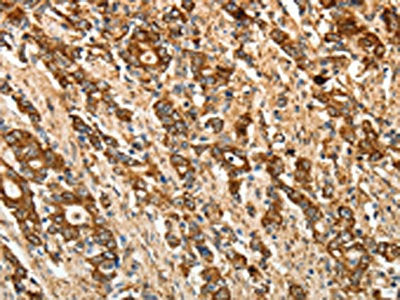 The image on the left is immunohistochemistry of paraffin-embedded Human gastic cancer tissue using the antibody Antibody) at dilution 1/50, on the right is treated with fusion protein. (Original magnification: ×200)