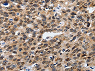The image on the left is immunohistochemistry of paraffin-embedded Human ovarian cancer tissue using SUMO1 Antibody(SUMO1 Antibody) at dilution 1/20, on the right is treated with synthetic peptide. (Original magnification: ×200)Rabbit anti-Human SUMO1 Polyclonal Antibody