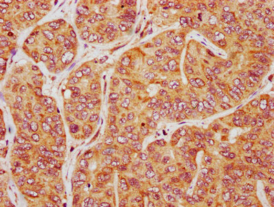IHC image of the antibody diluted at 1:200 and staining in paraffin-embedded human liver cancer performed on a Leica BondTM system. After dewaxing and hydration, antigen retrieval was mediated by high pressure in a citrate buffer (pH 6.0). Section was blocked with 10% normal goat serum 30min at RT. Then primary antibody (1% BSA) was incubated at 4°C overnight. The primary is detected by a biotinylated secondary antibody and visualized using an HRP conjugated SP system.Rabbit anti-Human PIRT Polyclonal Antibody