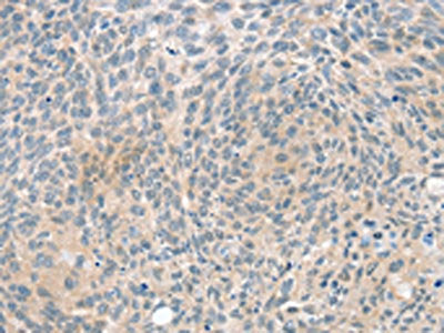 The image on the left is immunohistochemistry of paraffin-embedded Human esophagus cancer tissue using PPP2CA Antibody(PPP2CA Antibody) at dilution 1/20, on the right is treated with fusion protein. (Original magnification: ×200)Rabbit anti-Human PPP2CA Polyclonal Antibody