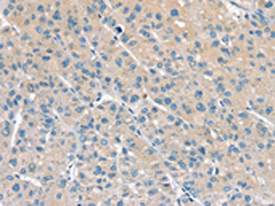 The image on the left is immunohistochemistry of paraffin-embedded Human liver cancer tissue using the antibody Antibody) at dilution 1/20, on the right is treated with fusion protein. (Original magnification: ×200)Rabbit anti-Human PPP2CA Polyclonal Antibody