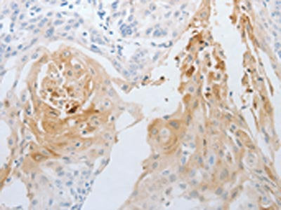 The image on the left is immunohistochemistry of paraffin-embedded Human cervical cancer tissue using NGFR Antibody(NGFR Antibody) at dilution 1/30, on the right is treated with synthetic peptide. (Original magnification: ×200)Rabbit anti-Human NGFR Polyclonal Antibody