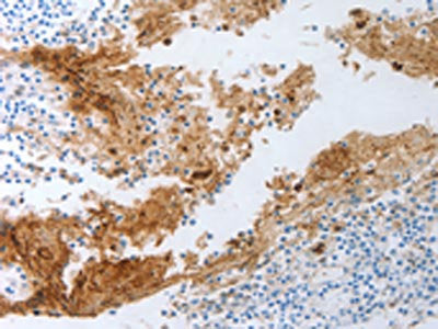 The image on the left is immunohistochemistry of paraffin-embedded Human tonsil tissue using the antibody Antibody) at dilution 1/30, on the right is treated with synthetic peptide. (Original magnification: ×200)Rabbit anti-Human NGFR Polyclonal Antibody