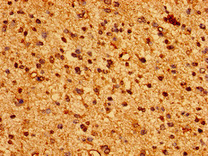 Immunohistochemistry of paraffin-embedded human glioma using HLA-C Antibody at dilution of 1:100