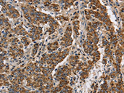 The image on the left is immunohistochemistry of paraffin-embedded Human liver cancer tissue using the antibody Antibody) at dilution 1/40, on the right is treated with synthetic peptide. (Original magnification: ×200)