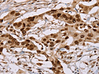 The image on the left is immunohistochemistry of paraffin-embedded Human colon cancer tissue using NUP50 Antibody(NUP50 Antibody) at dilution 1/30, on the right is treated with fusion protein. (Original magnification: ×200)Rabbit anti-Human NUP50 Polyclonal Antibody