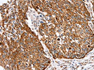 The image on the left is immunohistochemistry of paraffin-embedded Human lung cancer tissue using SSBP1 Antibody(SSBP1 Antibody) at dilution 1/30, on the right is treated with fusion protein. (Original magnification: ×200)Rabbit anti-Human SSBP1 Polyclonal Antibody
