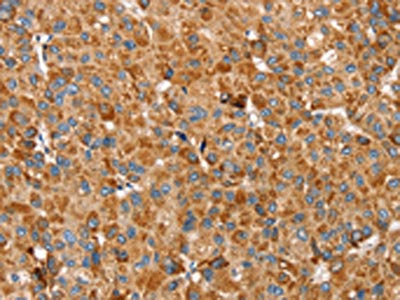 The image on the left is immunohistochemistry of paraffin-embedded Human liver cancer tissue using the antibody Antibody) at dilution 1/30, on the right is treated with fusion protein. (Original magnification: ×200)Rabbit anti-Human SSBP1 Polyclonal Antibody