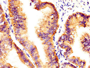 IHC image of AXL Antibody diluted at 1:400 and staining in paraffin-embedded human endometrial cancer performed on a Leica BondTM system. After dewaxing and hydration, antigen retrieval was mediated by high pressure in a citrate buffer (pH 6.0). Section was blocked with 10% normal goat serum 30min at RT. Then primary antibody (1% BSA) was incubated at 4°C overnight. The primary is detected by a biotinylated secondary antibody and visualized using an HRP conjugated SP system.