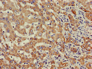 Immunohistochemistry of paraffin-embedded human liver cancer using SDC4 Antibody at dilution of 1:100Rabbit anti-Human SDC4 Polyclonal Antibody