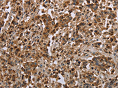 The image on the left is immunohistochemistry of paraffin-embedded Human liver cancer tissue using CFLAR Antibody(CFLAR Antibody) at dilution 1/20, on the right is treated with synthetic peptide. (Original magnification: ×200)Rabbit anti-Human CFLAR Polyclonal Antibody