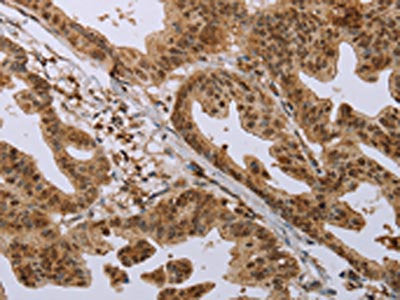 The image on the left is immunohistochemistry of paraffin-embedded Human gastic cancer tissue using the antibody Antibody) at dilution 1/20, on the right is treated with synthetic peptide. (Original magnification: ×200)Rabbit anti-Human CFLAR Polyclonal Antibody