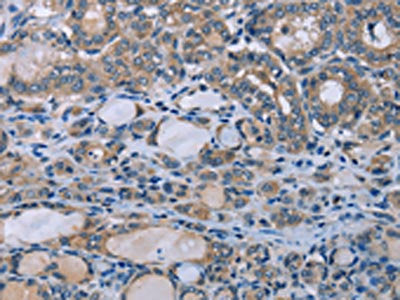 The image on the left is immunohistochemistry of paraffin-embedded Human thyroid cancer tissue using HOMER1 Antibody(HOMER1 Antibody) at dilution 1/50, on the right is treated with fusion protein. (Original magnification: ×200)Rabbit anti-Human HOMER1 Polyclonal Antibody