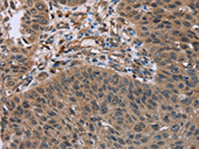 The image on the left is immunohistochemistry of paraffin-embedded Human lung cancer tissue using the antibody Antibody) at dilution 1/50, on the right is treated with fusion protein. (Original magnification: ×200)Rabbit anti-Human HOMER1 Polyclonal Antibody