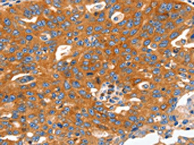 The image on the left is immunohistochemistry of paraffin-embedded Human ovarian cancer tissue using the antibody Antibody) at dilution 1/60, on the right is treated with fusion protein. (Original magnification: ×200)