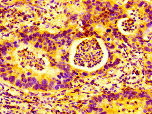 IHC image of AMFR Antibody diluted at 1:100 and staining in paraffin-embedded human bladder cancer performed on a Leica BondTM system. After dewaxing and hydration, antigen retrieval was mediated by high pressure in a citrate buffer (pH 6.0). Section was blocked with 10% normal goat serum 30min at RT. Then primary antibody (1% BSA) was incubated at 4°C overnight. The primary is detected by a biotinylated secondary antibody and visualized using an HRP conjugated SP system.Rabbit anti-Human AMFR Polyclonal Antibody