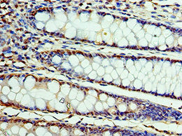 Immunohistochemistry of paraffin-embedded human colon cancer using CSTF2 Antibody at dilution of 1:100Rabbit anti-Human CSTF2 Polyclonal Antibody