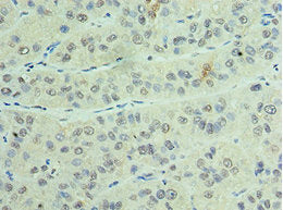 Immunohistochemistry of paraffin-embedded human liver cancer using CSTF2 Antibody at dilution of 1:100Rabbit anti-Human CSTF2 Polyclonal Antibody