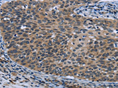 The image on the left is immunohistochemistry of paraffin-embedded Human cervical cancer tissue using AVEN Antibody(AVEN Antibody) at dilution 1/30, on the right is treated with synthetic peptide. (Original magnification: ×200)Rabbit anti-Human AVEN Polyclonal Antibody