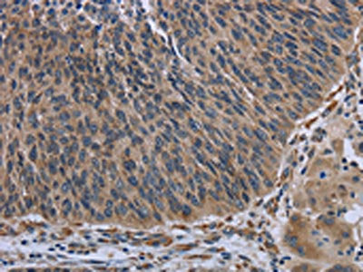 The image on the left is immunohistochemistry of paraffin-embedded Human lung cancer tissue using the antibody Antibody) at dilution 1/30, on the right is treated with synthetic peptide. (Original magnification: ×200)Rabbit anti-Human AVEN Polyclonal Antibody