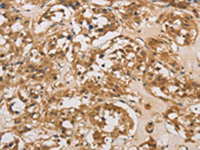 The image on the left is immunohistochemistry of paraffin-embedded Human thyroid cancer tissue using DAB2 Antibody(DAB2 Antibody) at dilution 1/25, on the right is treated with fusion protein. (Original magnification: ×200)Rabbit anti-Human DAB2 Polyclonal Antibody