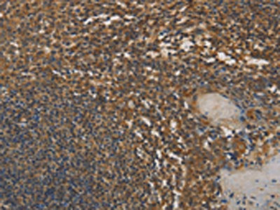 The image on the left is immunohistochemistry of paraffin-embedded Human tonsil tissue using the antibody Antibody) at dilution 1/25, on the right is treated with fusion protein. (Original magnification: ×200)Rabbit anti-Human DAB2 Polyclonal Antibody