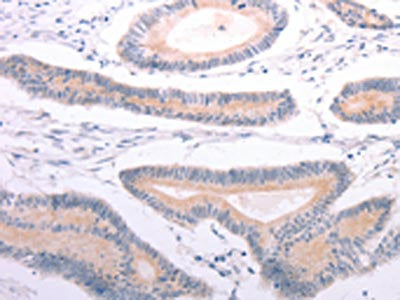 The image on the left is immunohistochemistry of paraffin-embedded Human colon cancer tissue using the antibody Antibody) at dilution 1/20, on the right is treated with synthetic peptide. (Original magnification: ×200)Rabbit anti-Human ANGPTL2 Polyclonal Antibody