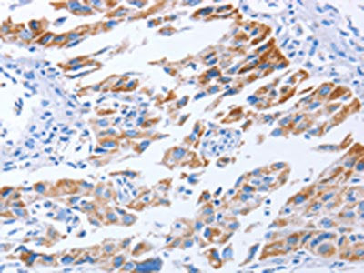 The image on the left is immunohistochemistry of paraffin-embedded Human lung cancer tissue using KIF3A Antibody(KIF3A Antibody) at dilution 1/40, on the right is treated with fusion protein. (Original magnification: ×200)