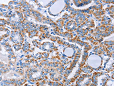 The image on the left is immunohistochemistry of paraffin-embedded Human thyroid cancer tissue using the antibody Antibody) at dilution 1/40, on the right is treated with fusion protein. (Original magnification: ×200)
